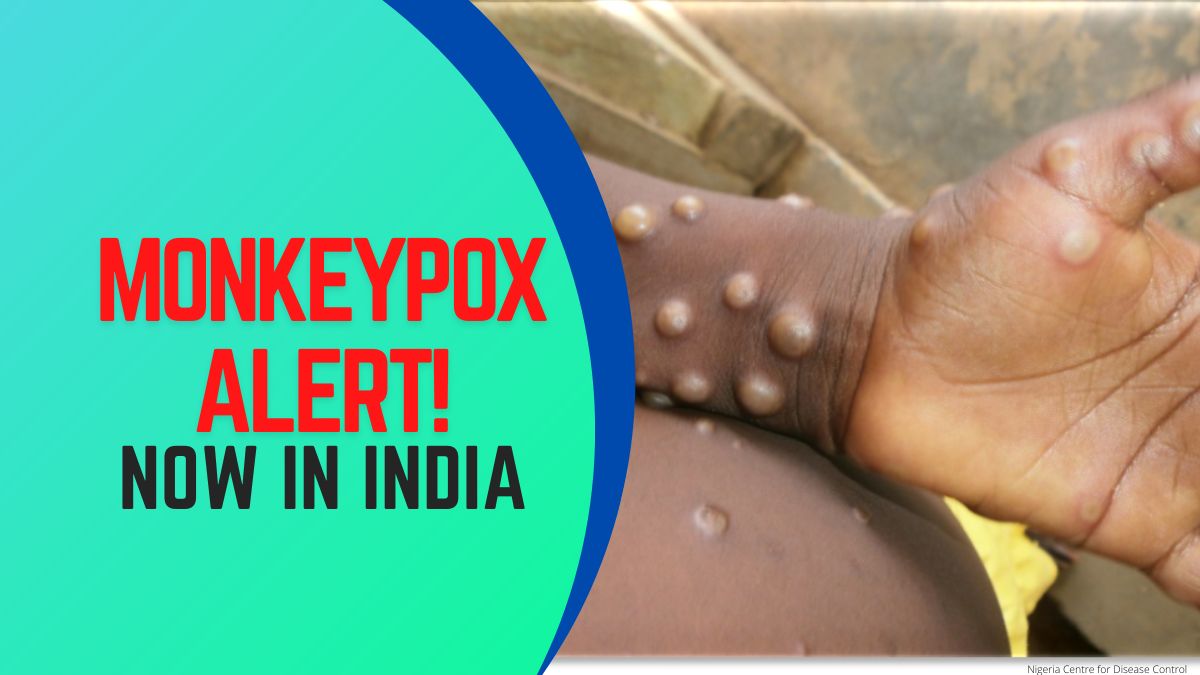monkeypox disease alert now in india